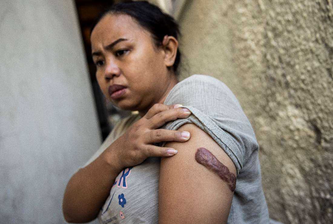 In this file photo taken on Oct. 7, 2022, Indonesian woman Kartika Puspitasari shows a scar on her arm from an injury inflicted by previous employers, at Bethune House, a shelter operated by the migrant worker advocacy group (MFMW), in Hong Kong
