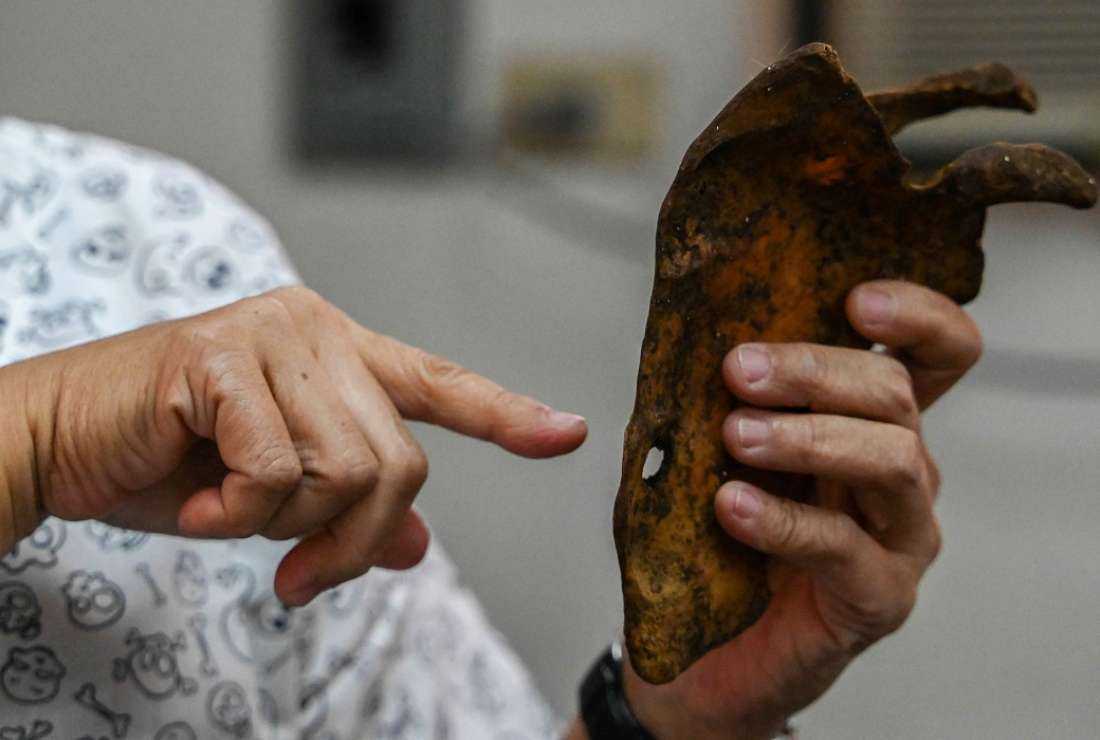 This photo taken on June 17, 2022 shows forensic pathologist pointing at a scapula with a bullet hole during a post mortem medical examination of an exhumed drug war victim, at the University of the Philippines Manila, in Manila